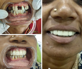 Root Canal Treatment & Crown and Bridges