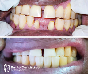 Root Canal Treatment & Crown and Bridges