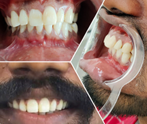 Teeth Alignment Braces