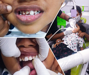 Pulpectomy for Pedo & Zirconia Crown Placed