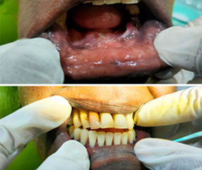 Removable Partial Denture