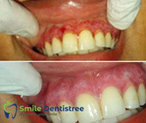 Gingival Depigmentation