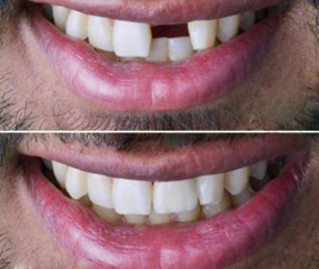 implant teeth treatment