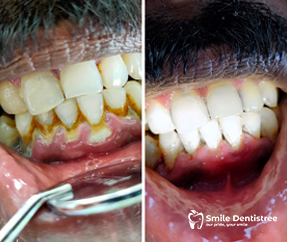teeth whitening treatment